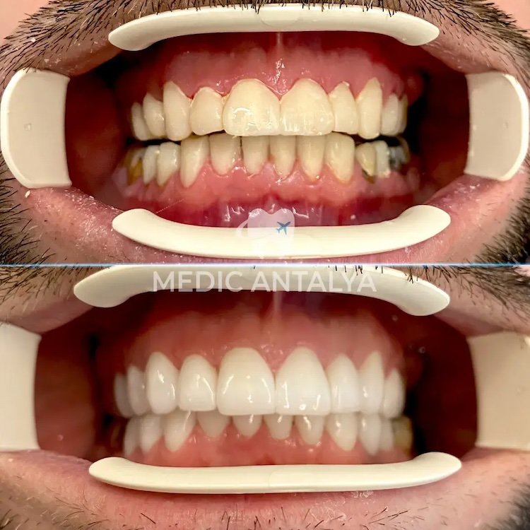 Facettes Dentaires — Medic Antalya