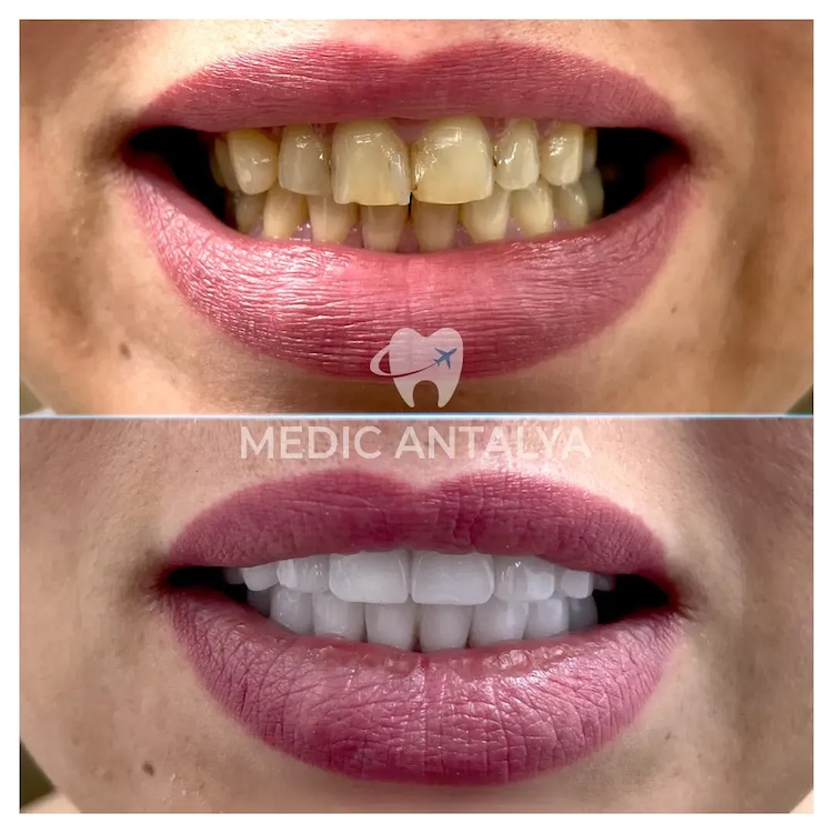 Facettes Dentaires — Medic Antalya