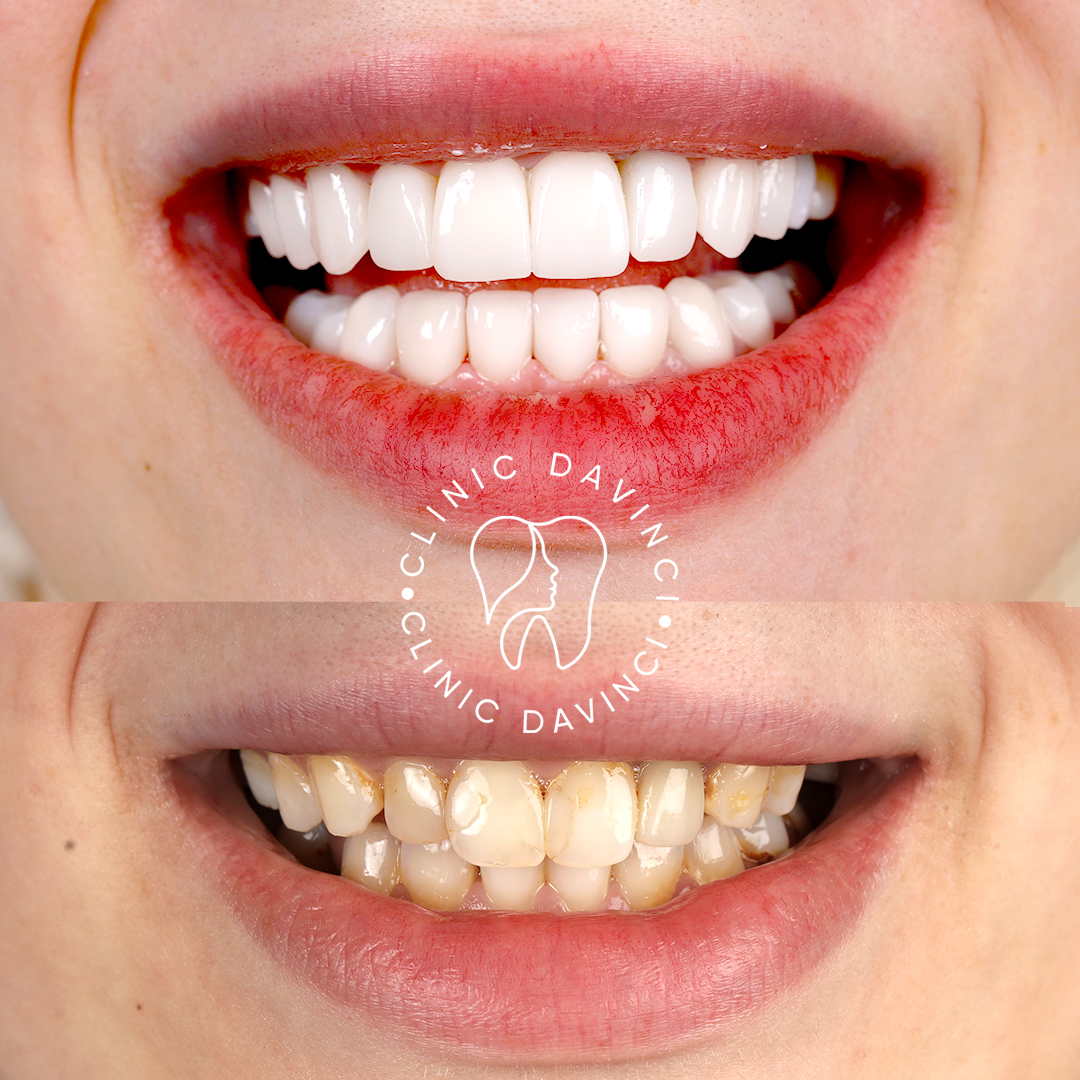 Hollywood Smile — Clinique Davinci