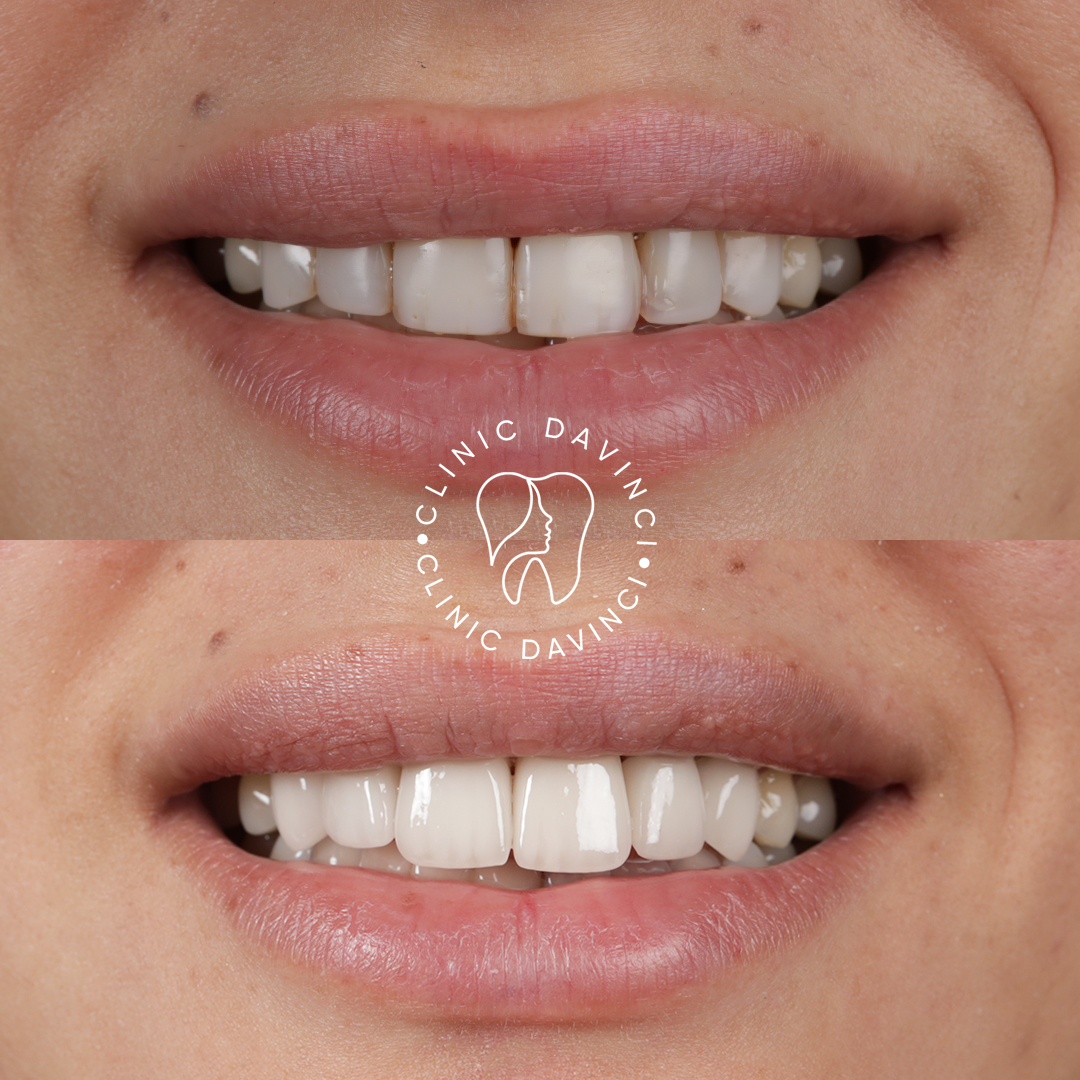 Hollywood Smile — Clinique Davinci