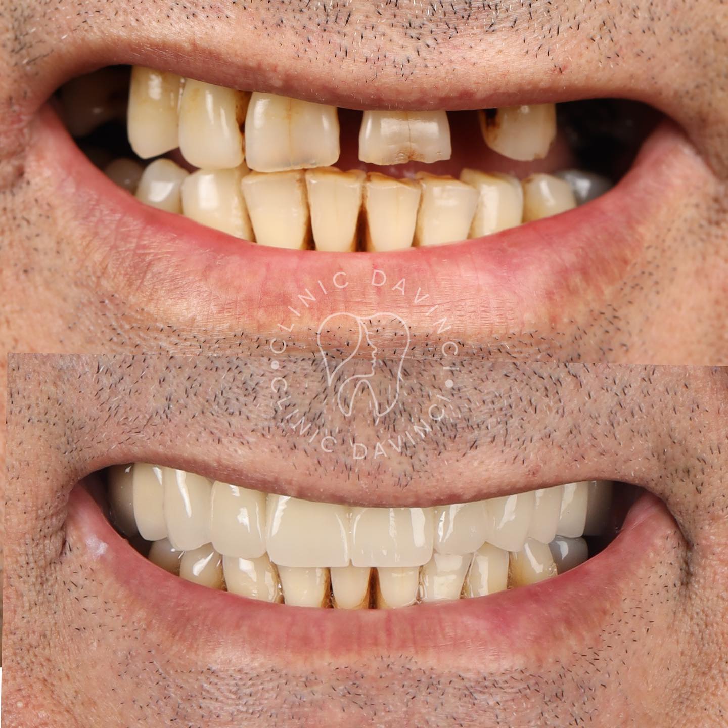 Hollywood Smile — Clinique Davinci