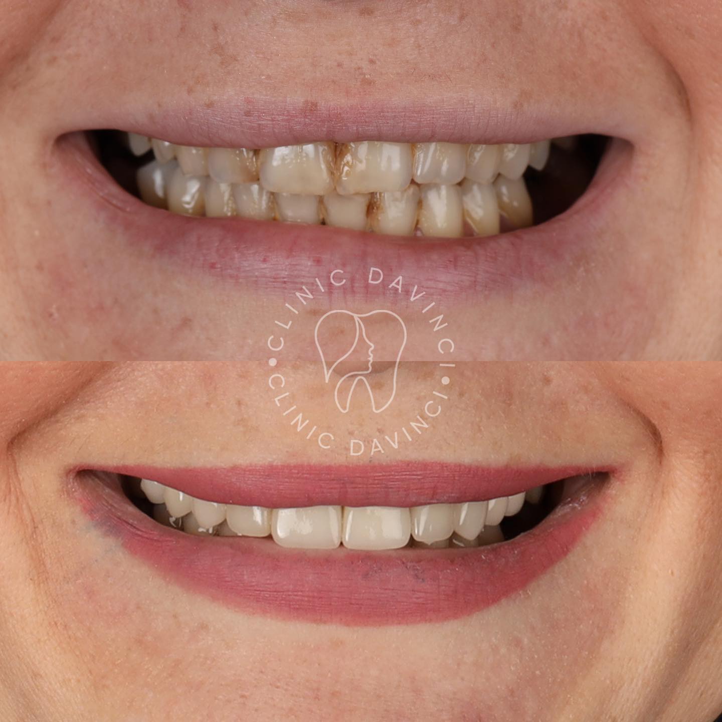 Hollywood Smile — Clinique Davinci