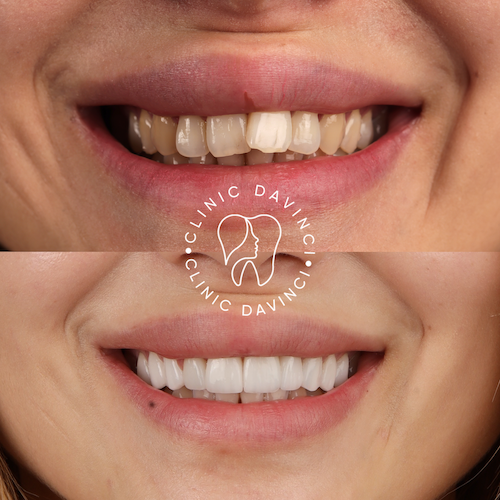 Hollywood Smile — Clinique Davinci