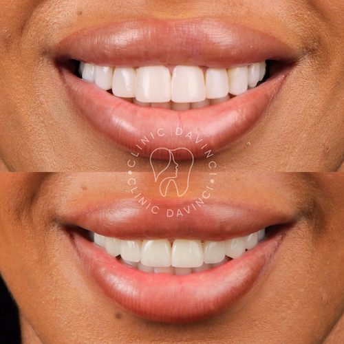 Hollywood Smile — Clinique Davinci