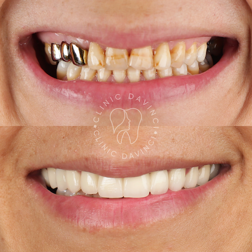 Hollywood Smile — Clinique Davinci