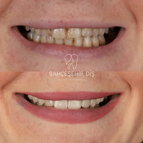 Hollywood Smile — Clinique Davinci