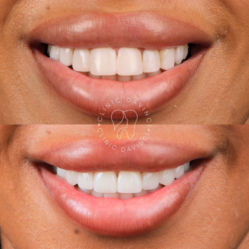 Hollywood Smile — Clinique Davinci