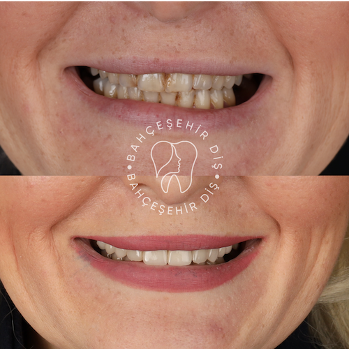 Hollywood Smile — Clinique Davinci