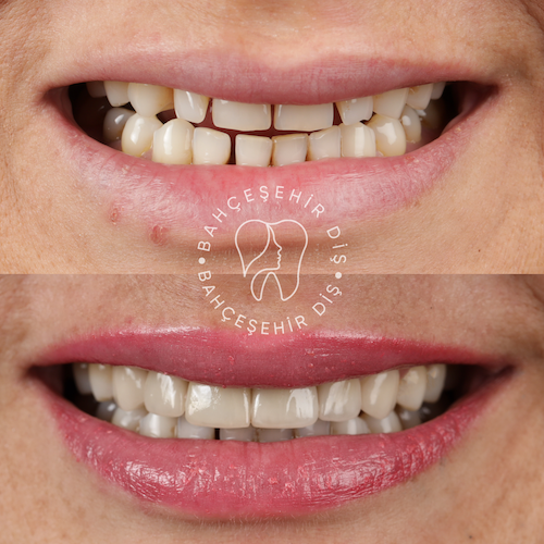 Hollywood Smile — Clinique Davinci