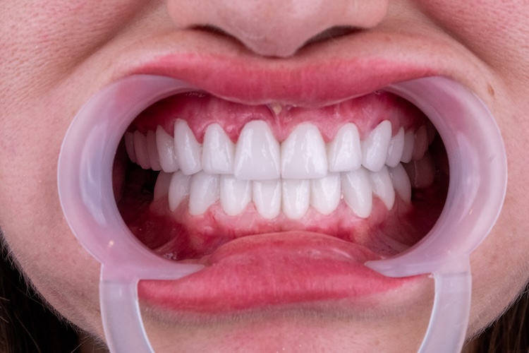 Corone dentali — ZenSmileTown