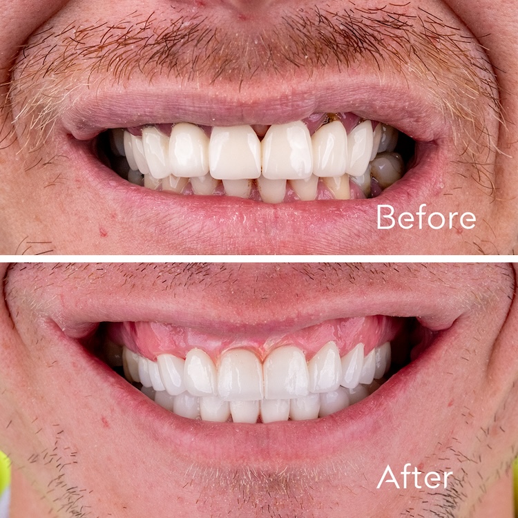 Corone dentali — ZenSmileTown
