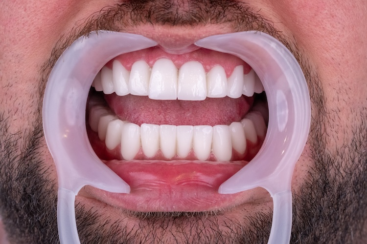 Corone dentali — ZenSmileTown