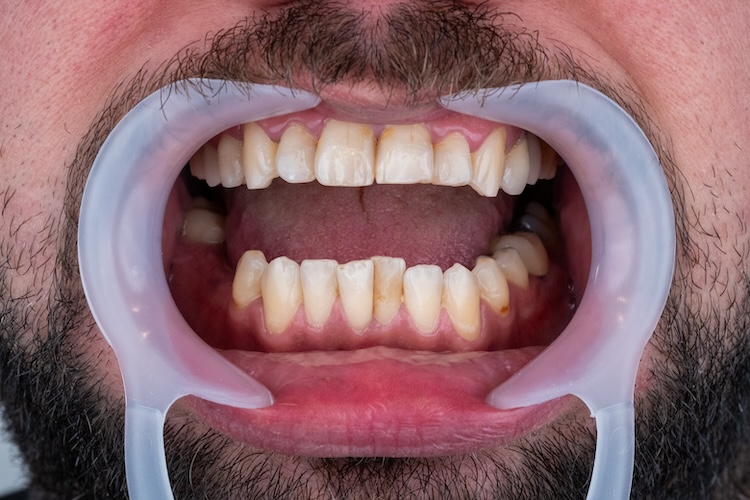 Corone dentali — ZenSmileTown