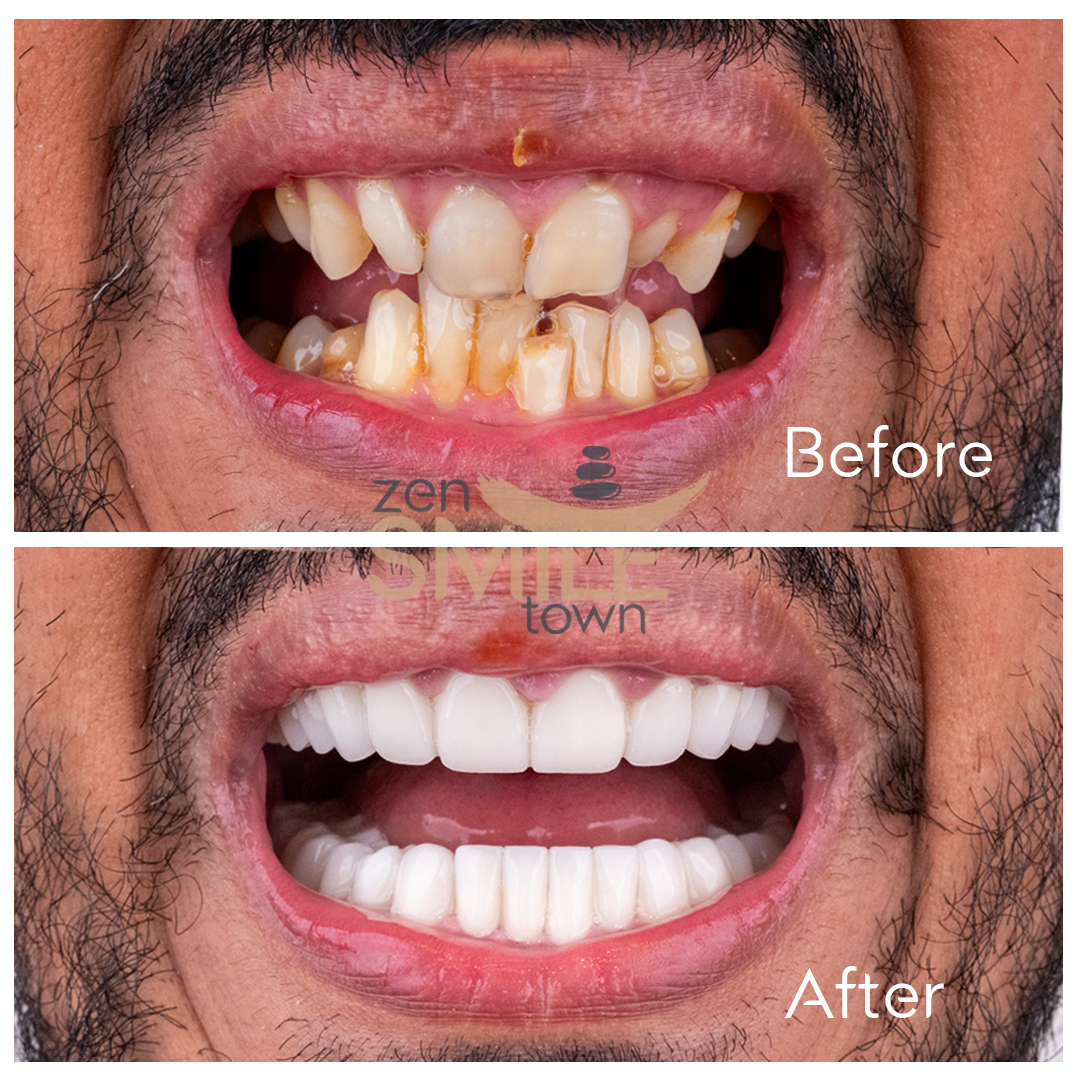 Corone dentali — ZenSmileTown