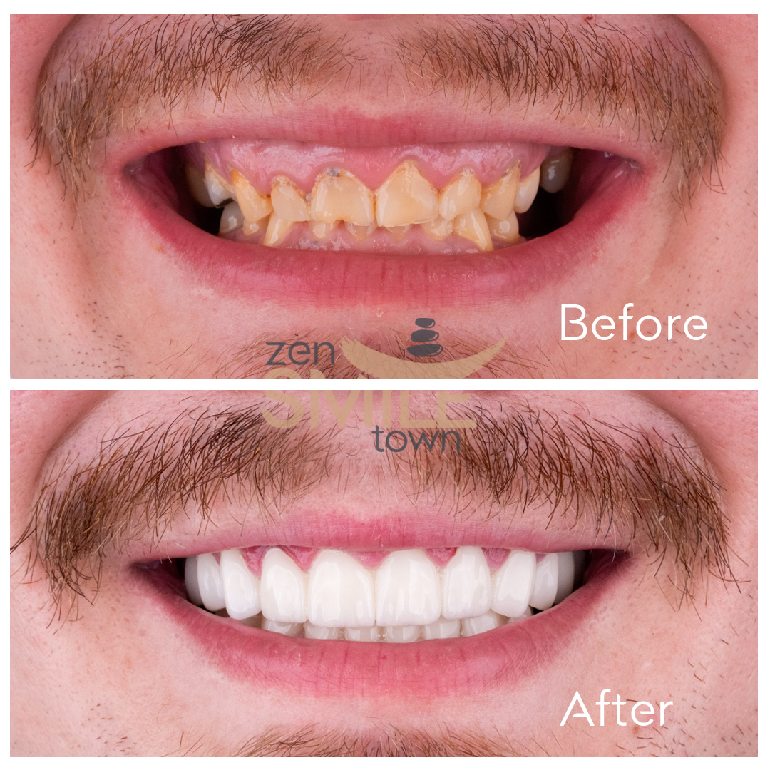 Corone dentali — ZenSmileTown