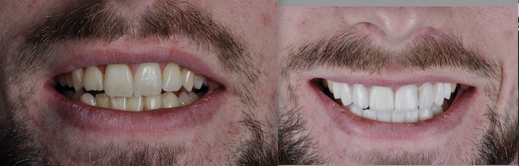 Hollywood Smile — Dentapoint