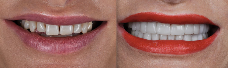 Hollywood Smile — Dentapoint