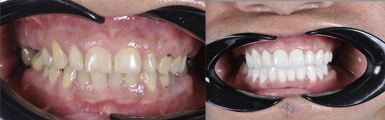 Hollywood Smile — Dentapoint