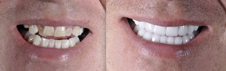Hollywood Smile — Dentapoint