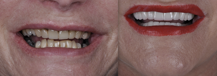 Hollywood Smile — Dentapoint