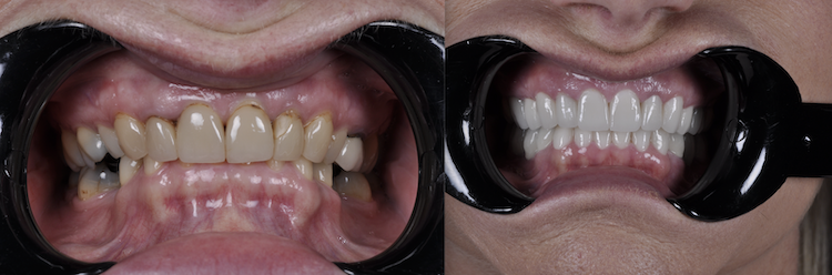 Hollywood Smile — Dentapoint