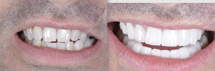 Hollywood Smile — Dentapoint