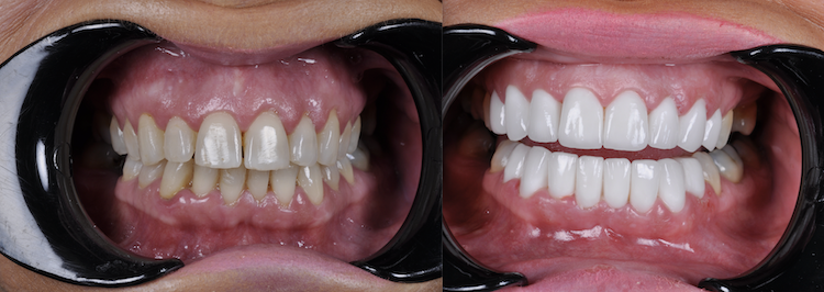 Hollywood Smile — Dentapoint