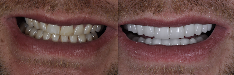 Hollywood Smile — Dentapoint