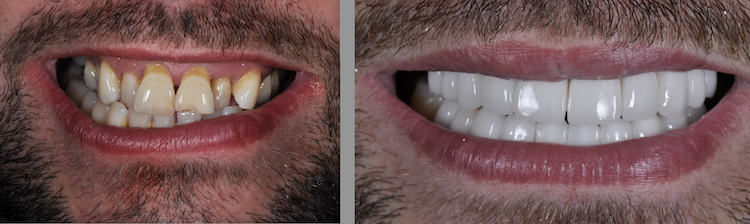Hollywood Smile — Dentapoint