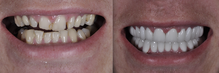Hollywood Smile — Dentapoint