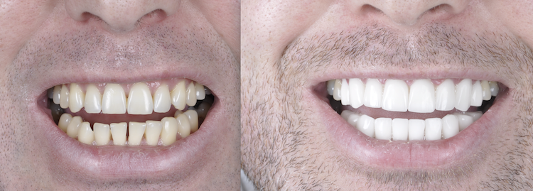Hollywood Smile — Dentapoint