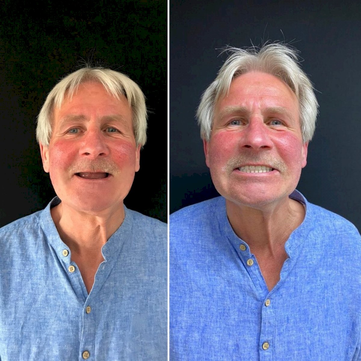 Implants Dentaires — Ephesus global dental