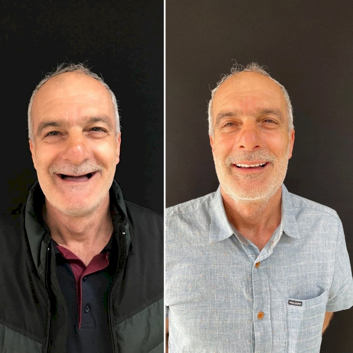Implants Dentaires — Ephesus global dental
