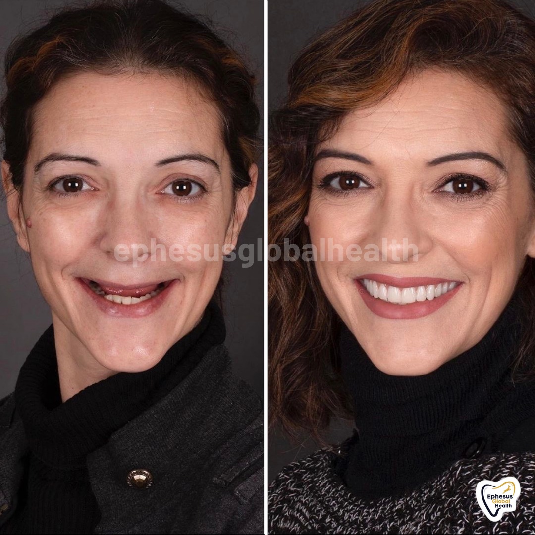 Implants Dentaires — Ephesus global dental