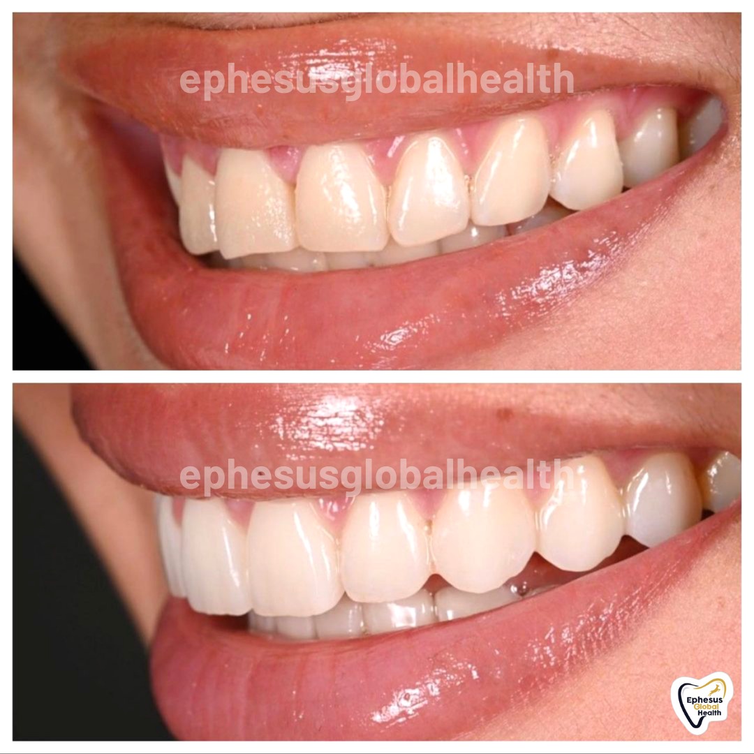 Couronnes Zircones — Ephesus global dental