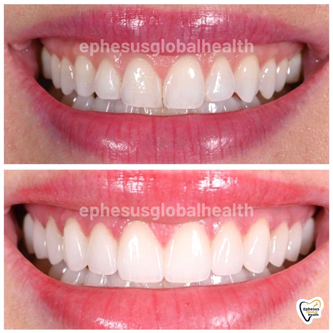 Couronnes Zircones — Ephesus global dental