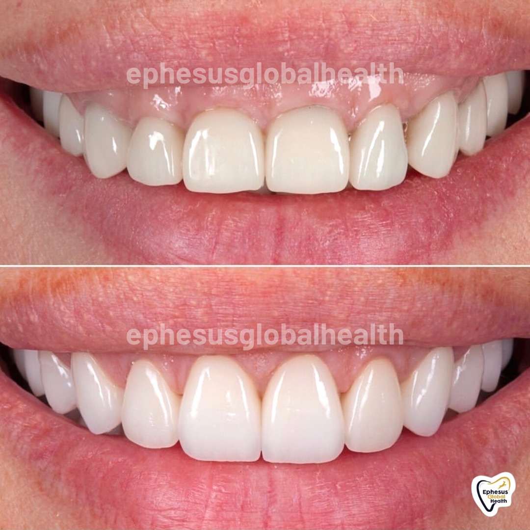 Couronnes Zircones — Ephesus global dental