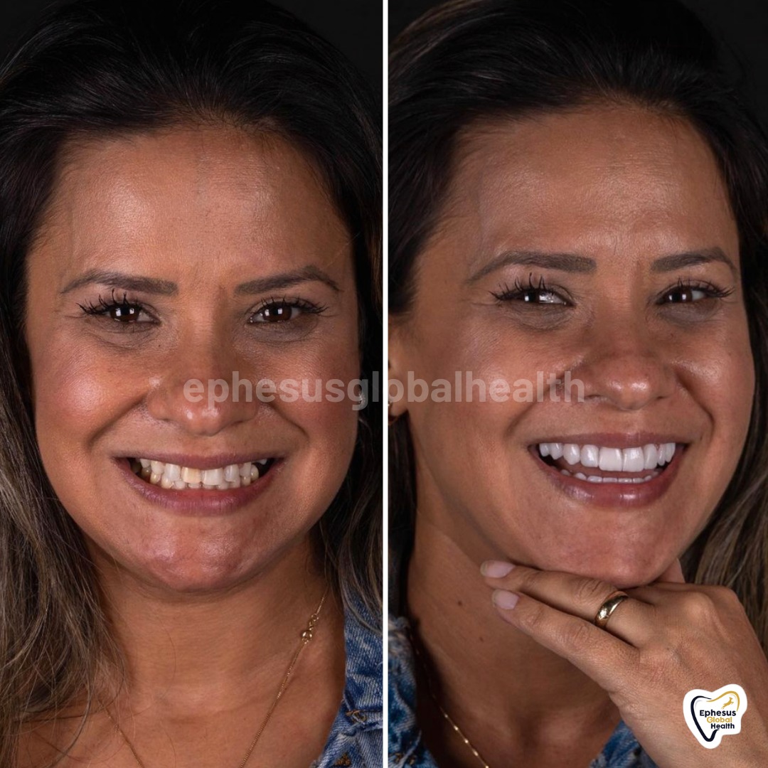 Couronnes Zircones — Ephesus global dental