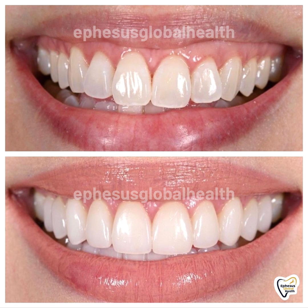 Couronnes Zircones — Ephesus global dental