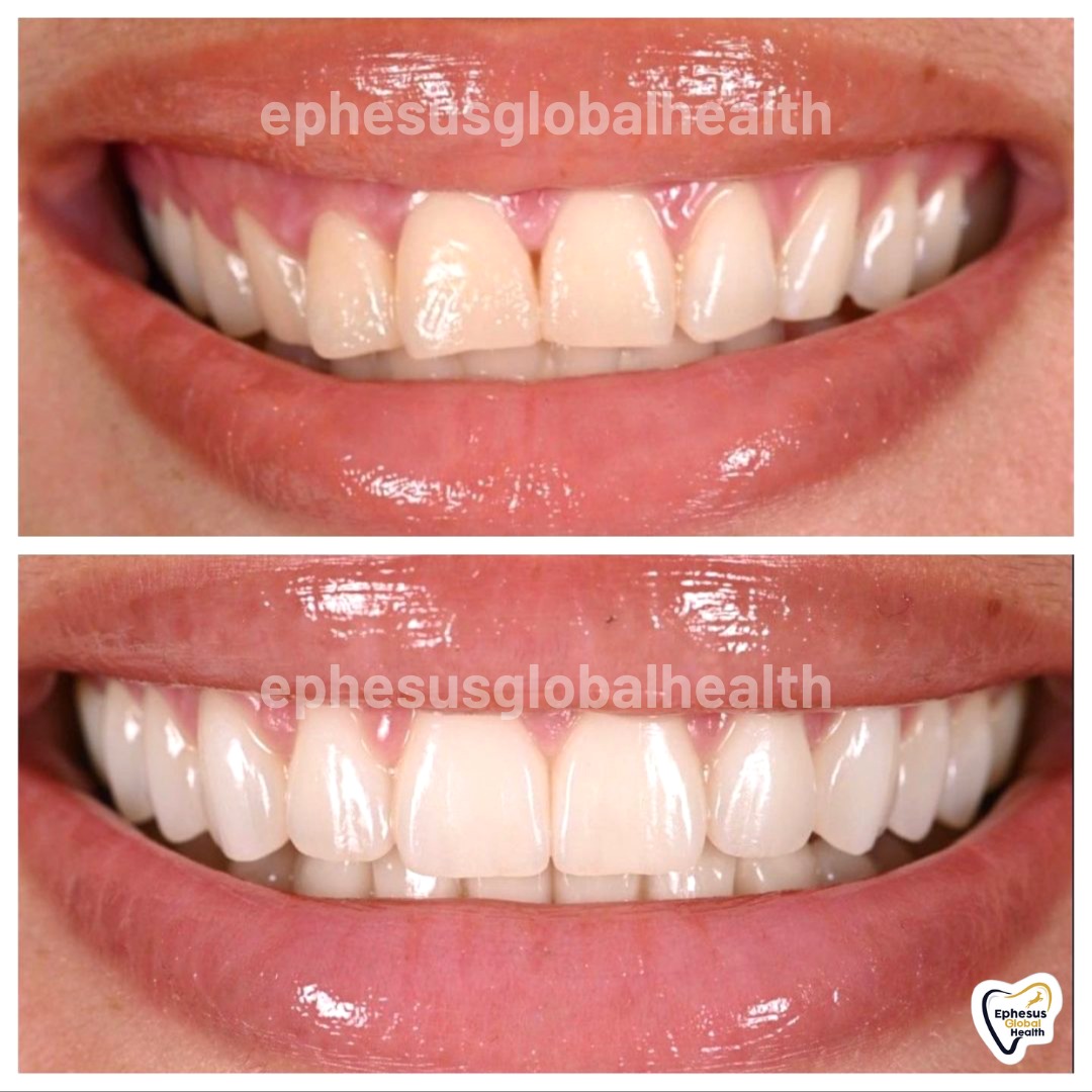 Couronnes Zircones — Ephesus global dental