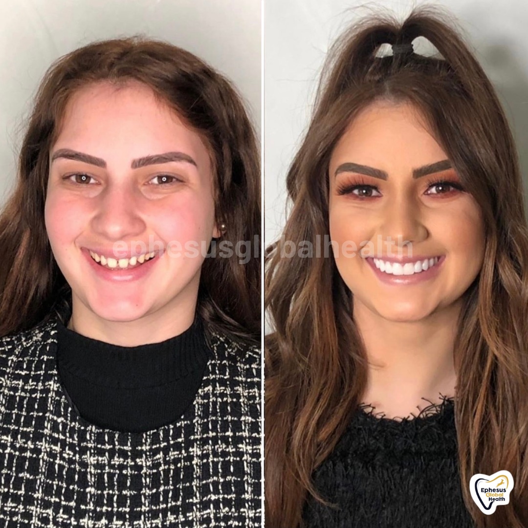 Couronnes Zircones — Ephesus global dental