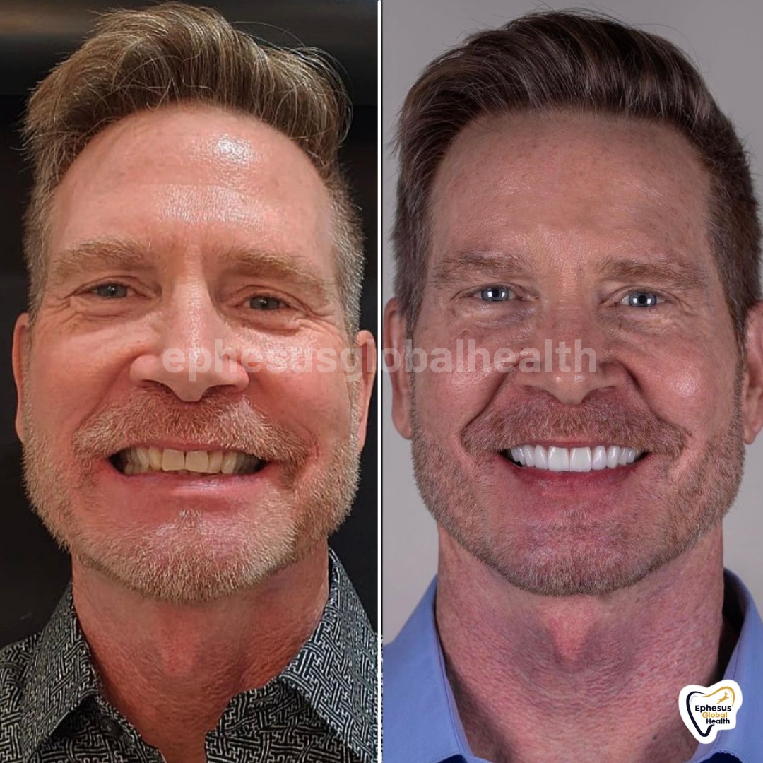 Couronnes Zircones — Ephesus global dental