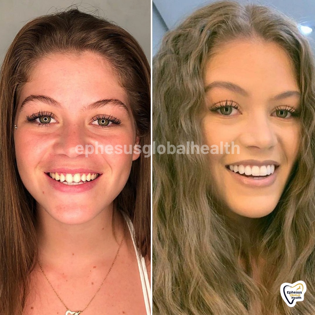 Couronnes Zircones — Ephesus global dental