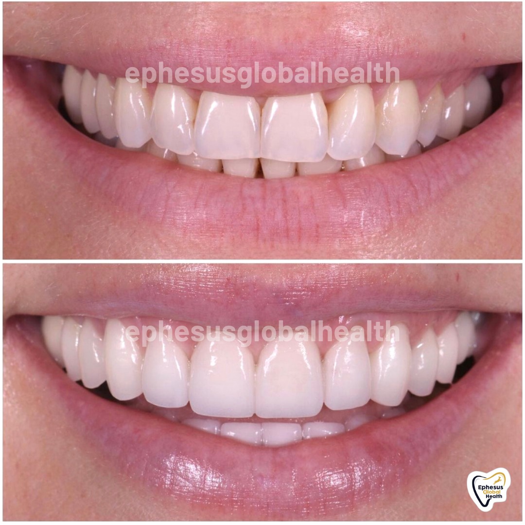 Couronnes Zircones — Ephesus global dental