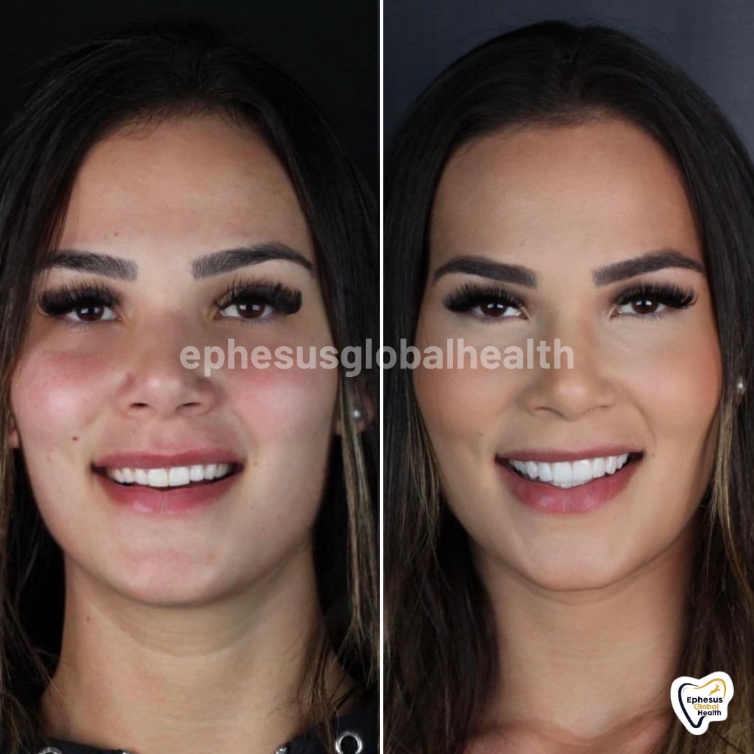 Couronnes Zircones — Ephesus global dental