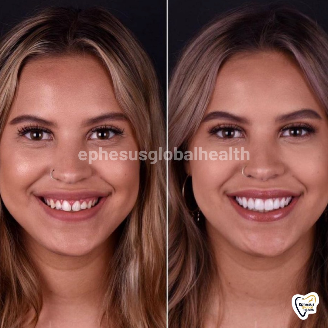 Couronnes Zircones — Ephesus global dental