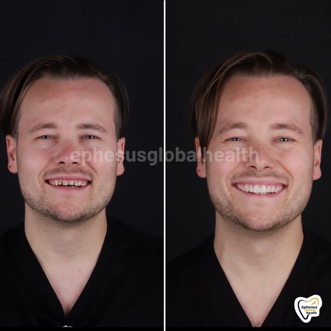 Couronnes Zircones — Ephesus global dental