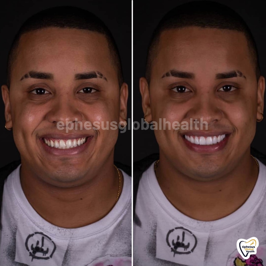 Couronnes Zircones — Ephesus global dental