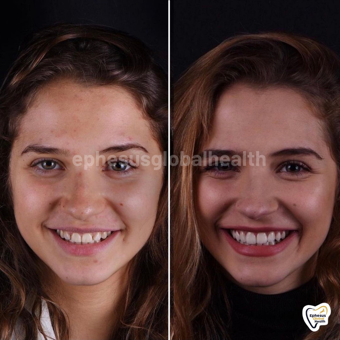 Couronnes Zircones — Ephesus global dental