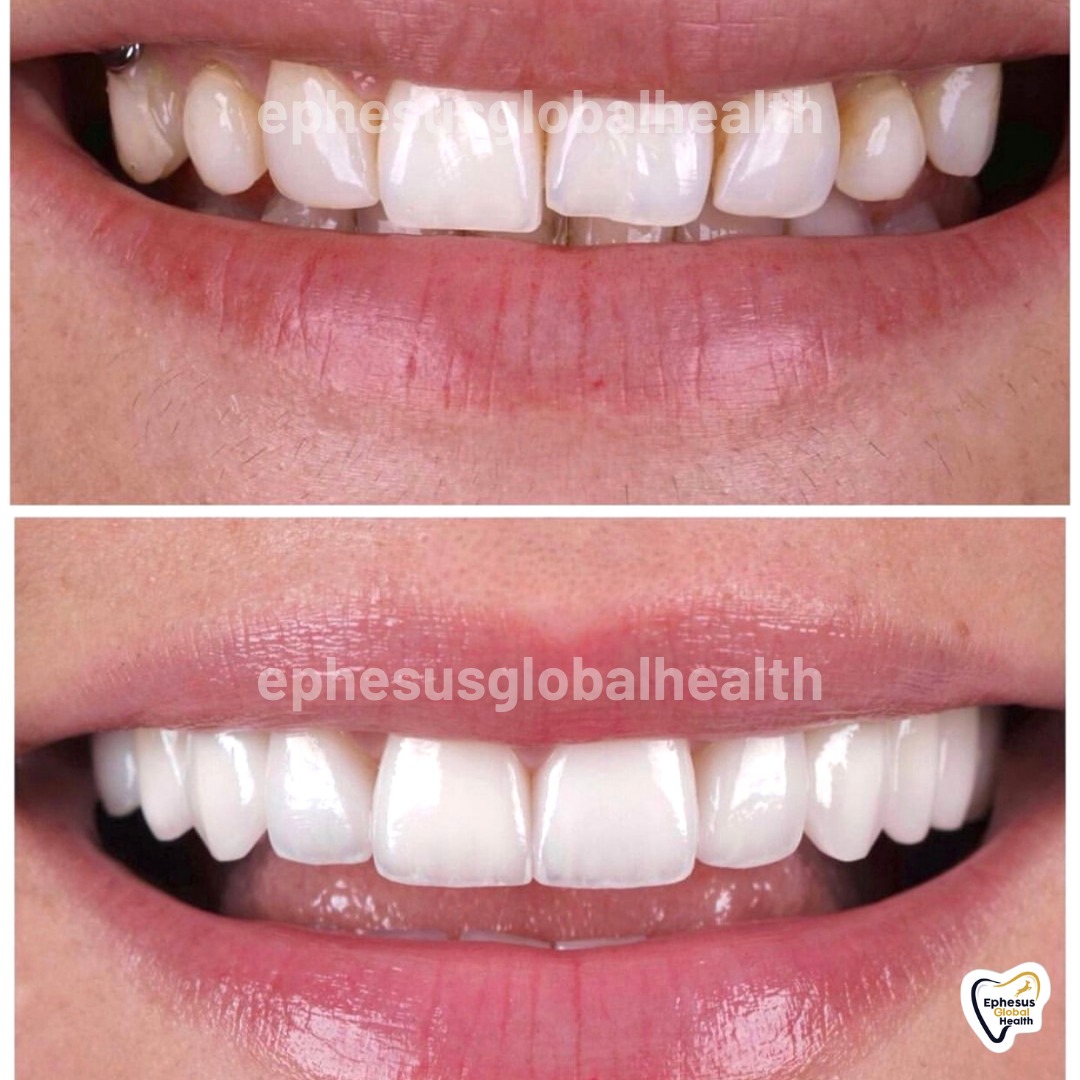 Couronnes Zircones — Ephesus global dental